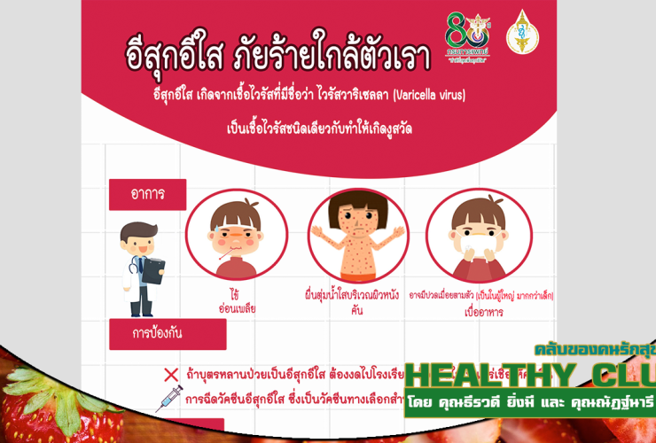 HealthClub โรคอีสุกอีใส